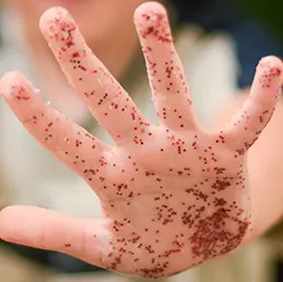 A child's open hand covered in red glitter, standing in for germs